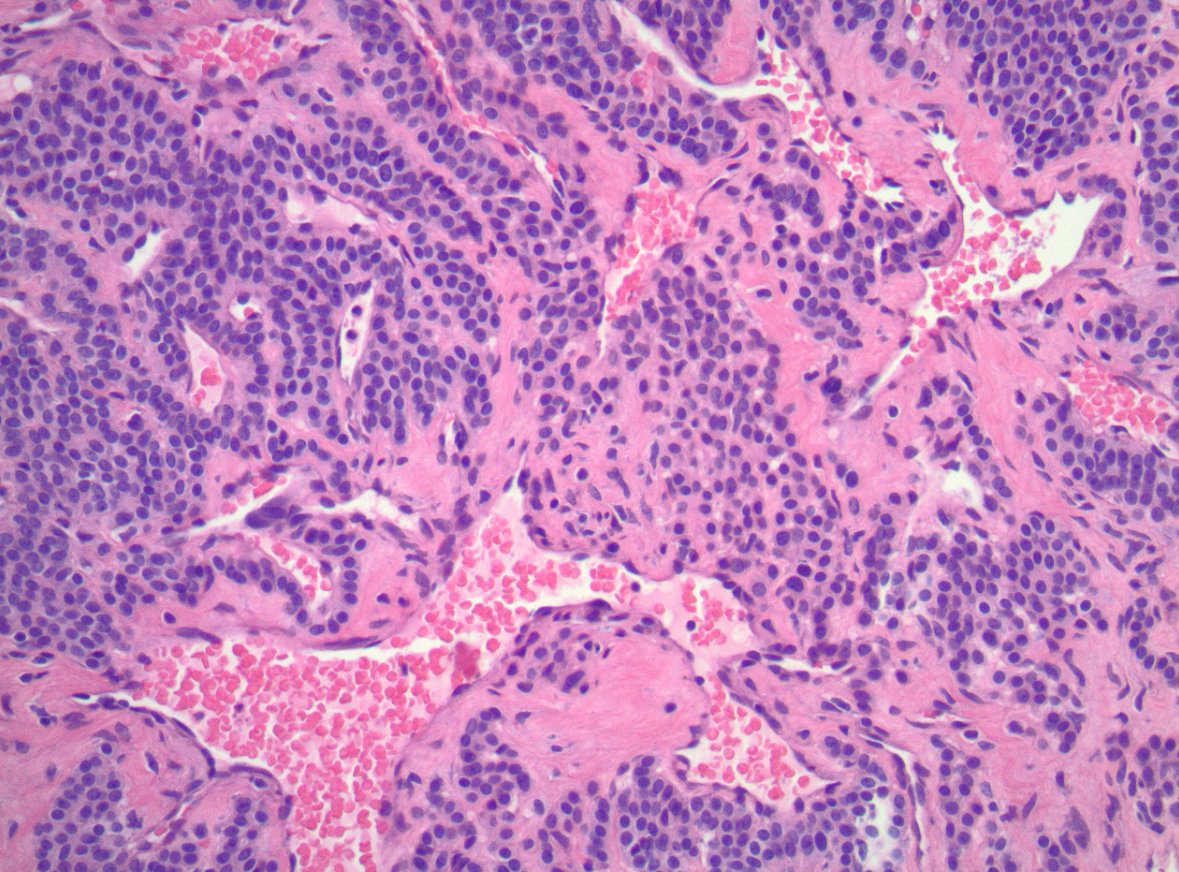 Here's another #BeautyintheBenign for the #PathResidents.

This cellular lesion is most commonly found as a painful nodule in the nail bed.

What do you think?

#PathTwitter #MedTwitter