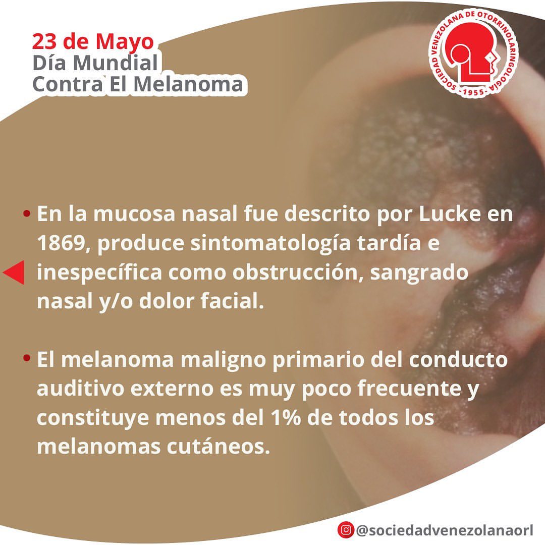 svorl's tweet photo. Día mundial del melanoma,acude al otorrino ante cualquier lesión en cabeza y cuello #SVORL #DiaMundialDelMelanoma https://t.co/mzp6ut5PoN