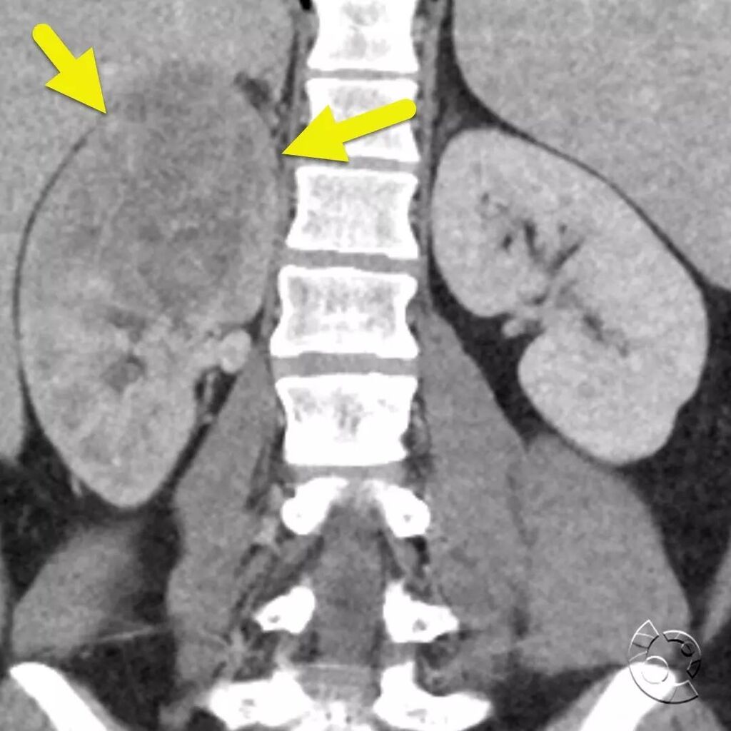 CincyKidsRad's tweet photo. Coronal (image 1) and axial (image 2 and 3) CT of the kidneys shows a poorly defined mass (arrow) in the upper pole of the right kidney. The mass was ultimately diagnosed as an extraosseous Ewing sarcoma. Extraosseous Ewing sarcoma is a rare variant of E… https://t.co/4U0cJqS72v https://t.co/5iLyKyRii4