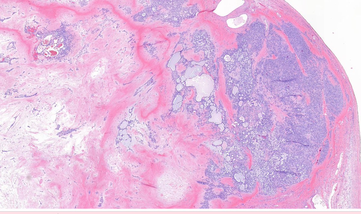 Janiranavarro's tweet photo. Ovary
Microcystic stromal tumor
-Microcysts
-Fibrous, thick collagen bands
-Fibrous stroma
➕B-catenin, cyclin D1
➖Inhibin, calretinin
DAPA grand rounds Dr. Oliva #EverydayGYN #gynpath #PathTwitter #pathologists #pathresidents #pathfellow https://t.co/vHdwJwkB2F