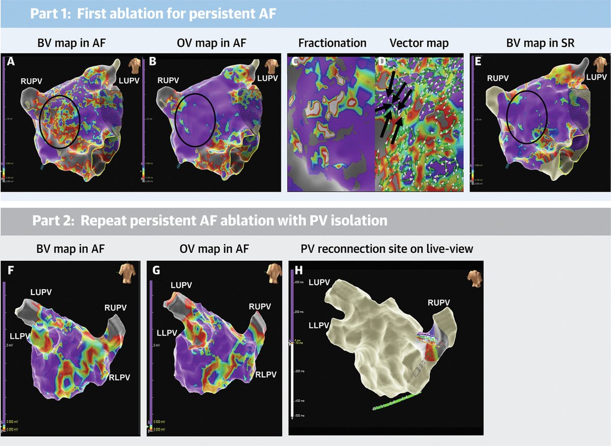 Caroline Roney (@carolineroney) on Twitter photo Exciting findings: In Atrial Fibrillation, Omnipolar Voltage Maps More Accurately Delineate Scar Than Bipolar Voltage Maps!
sciencedirect.com/science/articl…
Thanks to <a href="/axel_loewe/">Axel Loewe (axel-loewe.bsky.social)</a> and Dr Jadidi for the insightful editorial: sciencedirect.com/science/articl…
<a href="/Nikhil_Ahl/">Nikhil Ahluwalia</a> <a href="/LambiasePier/">Pier Lambiase</a> <a href="/amywharmby/">Amy Wharmby</a> Exciting findings: In Atrial Fibrillation, Omnipolar Voltage Maps More Accurately Delineate Scar Than Bipolar Voltage Maps!
sciencedirect.com/science/articl…
Thanks to <a href="/axel_loewe/">Axel Loewe (axel-loewe.bsky.social)</a> and Dr Jadidi for the insightful editorial: sciencedirect.com/science/articl…
<a href="/Nikhil_Ahl/">Nikhil Ahluwalia</a> <a href="/LambiasePier/">Pier Lambiase</a> <a href="/amywharmby/">Amy Wharmby</a>