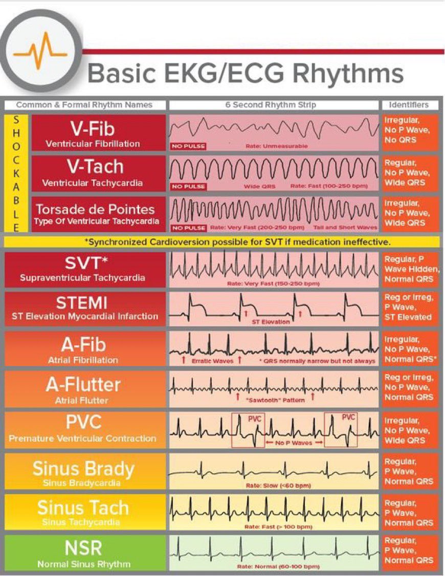 🫀 Basic ECG Rhythms

 #Cadiotwitter #MedEd #MedTwitter 
H/T <a href="/Innov_Medicine/">The Innovation | Medicine</a>