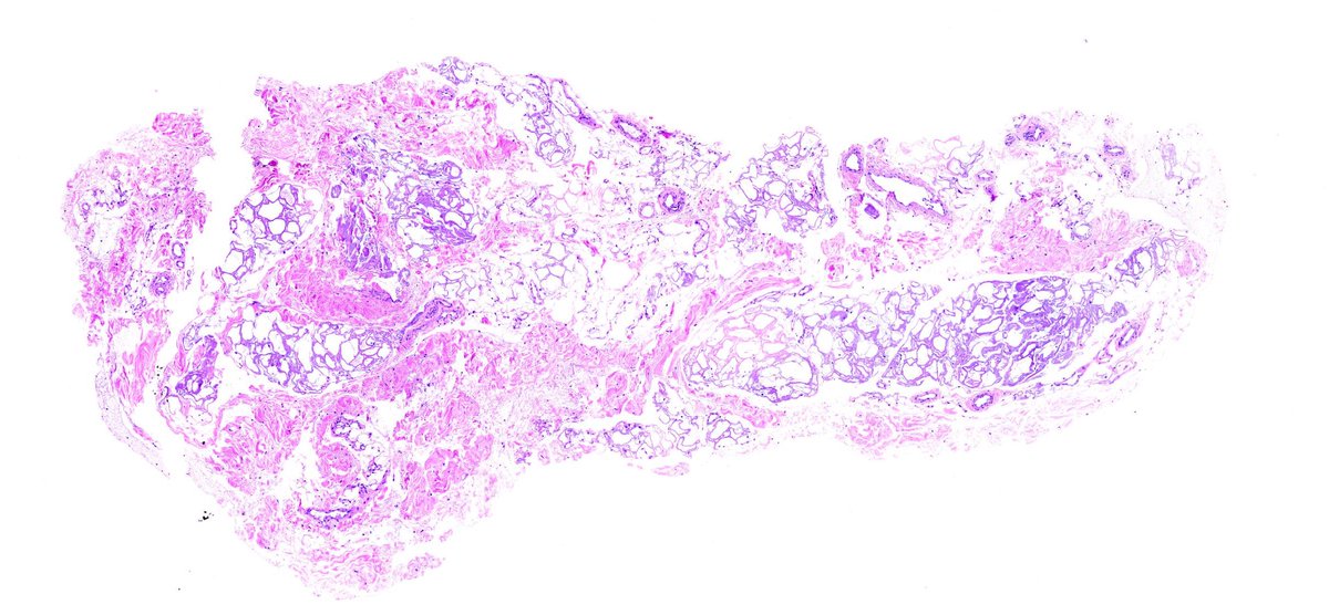 igor_dermpath's tweet photo. Whats´s happening here? What would you order (immunostain? special stain? other techniques?) and why? #dermpath #dermatopathology #dermatology #argospatologia
I'll post the answer tomorrow https://t.co/rkVnvDeEhJ