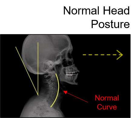 Agile_msk's tweet photo. If you're experiencing neck pain, it could be due to an unhealthy neck curve. Find out what causes an unhealthy neck curve and how to correct it in our latest blog post. https://t.co/HQBdNClyaw https://t.co/JX6SZWnNTw