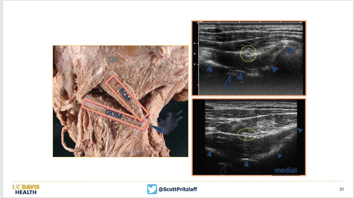 Thanks to @OchsnerHealth Division of Pain Medicine for opportunity to present innovative #Ultrasound techniques for the Distinguished Lecture Speaker Series yesterday. @EshraghiYashar @magedguirguis1 @ASRA_Society @DrOttestad