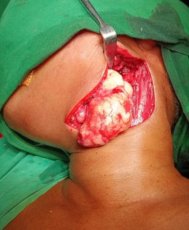 Ent_Faamch's tweet photo. Parapharyngeal Tumors are rare (0.5 to 01% incidence). Approaches can be Transcervical, Transparotid, Transmandibular or mixed. Challenges are many wrt all Imp. Neurovascular structures in PPS. https://t.co/AyNHVcEI9Y