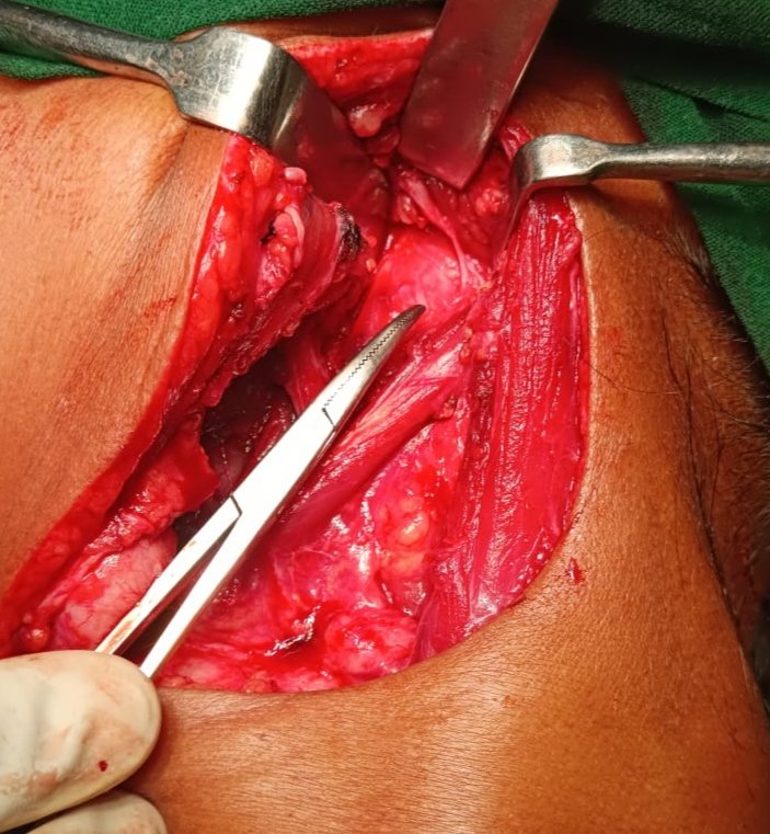Ent_Faamch's tweet photo. Patient planned for Stylohyoid Windowing procedure for tumor removal and a unique method of identifying facial trunk carried out by tracing Branch to Post belly of DG to reach the main trunk (retrograde)
Post op pic with tumor shown along with Cut section of the tumor. https://t.co/1k1jW4UBdo