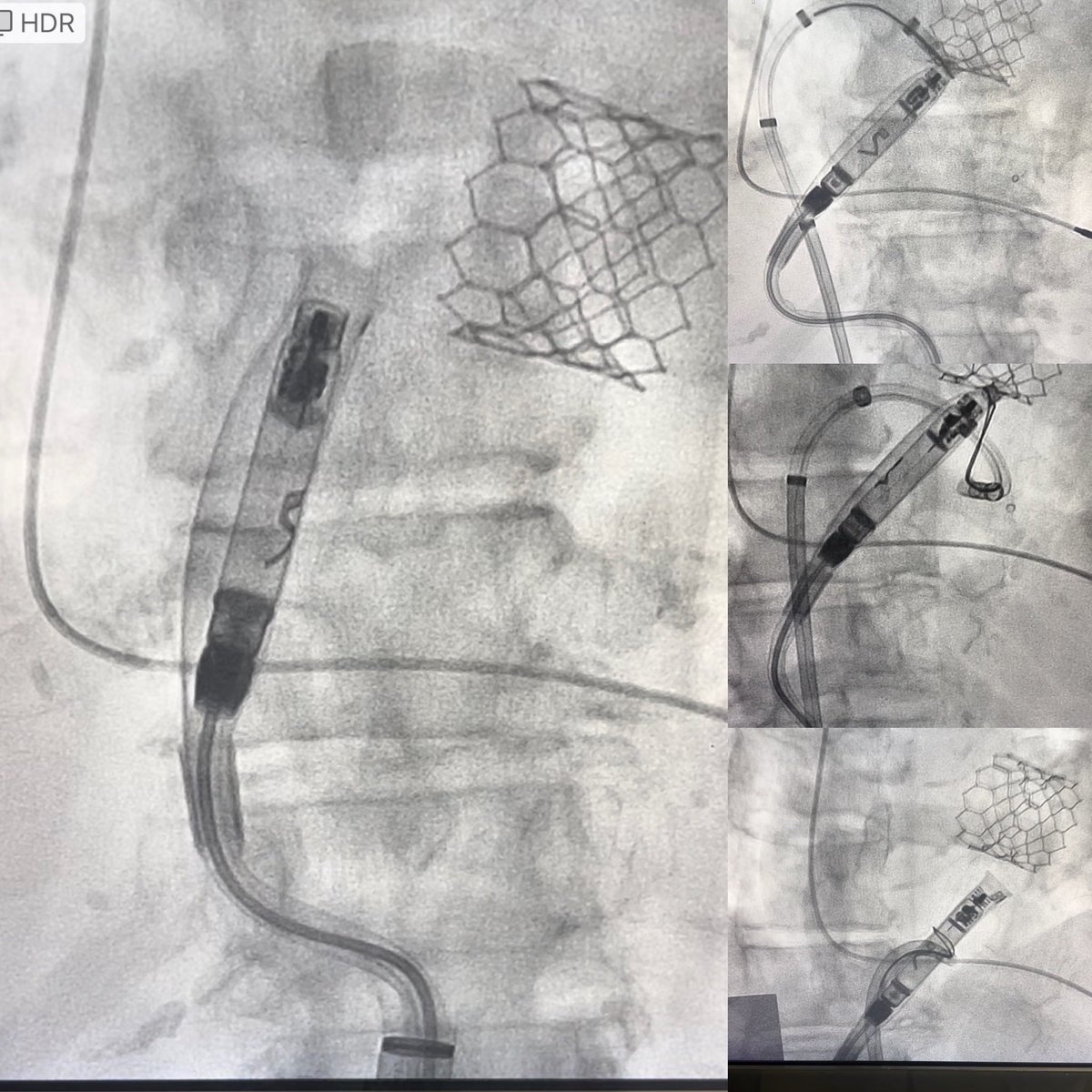 sumitvermaep's tweet photo. IVC tortuosity. Unable to get #Abbott Aveir to cross the TV despite help with a Vizigo and gooseneck snare #EPeeps https://t.co/Wd79aZEZD1