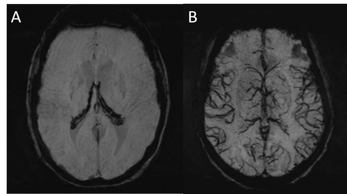 ShengChe's tweet image. [NeuroradNuggets] 
Two incidental intriguing SWI images. Both are related to chronic anemia. Guess what happened?