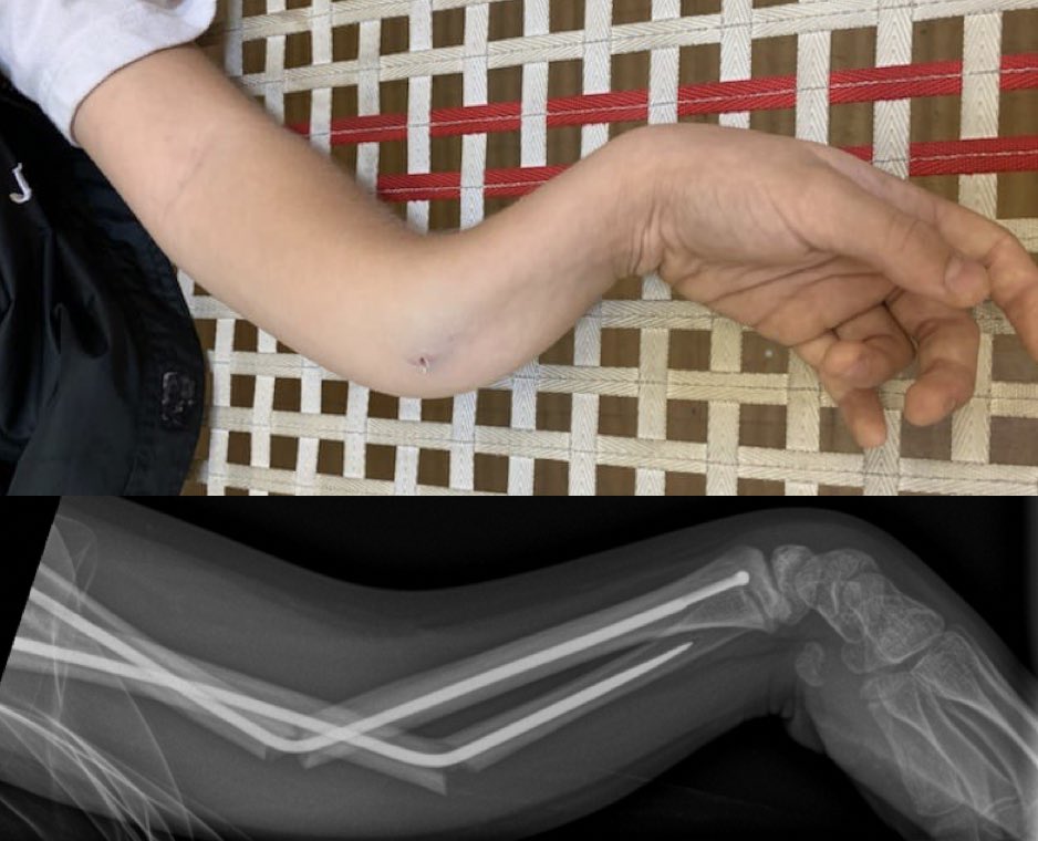 Pranai_B's tweet photo. Are you 😡 kidding me? 

What would #orthotwitter plan be ?

#TrampolineGrinch #TheKidsBoneDoc https://t.co/a7okxh7wj6