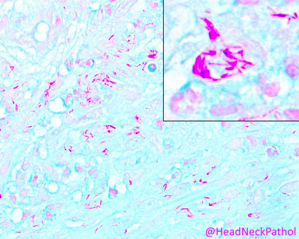 Mycobacterial Spindle Cell Pseudotumor of the Nasal Cavity By Prokopios P. Argyris & Paul E. Wakely Jr rdcu.be/dcO1p #HeadNeckPathol #HNPJ #HeadandNeckPath #Pathology #ENTPath #PathologyTweet