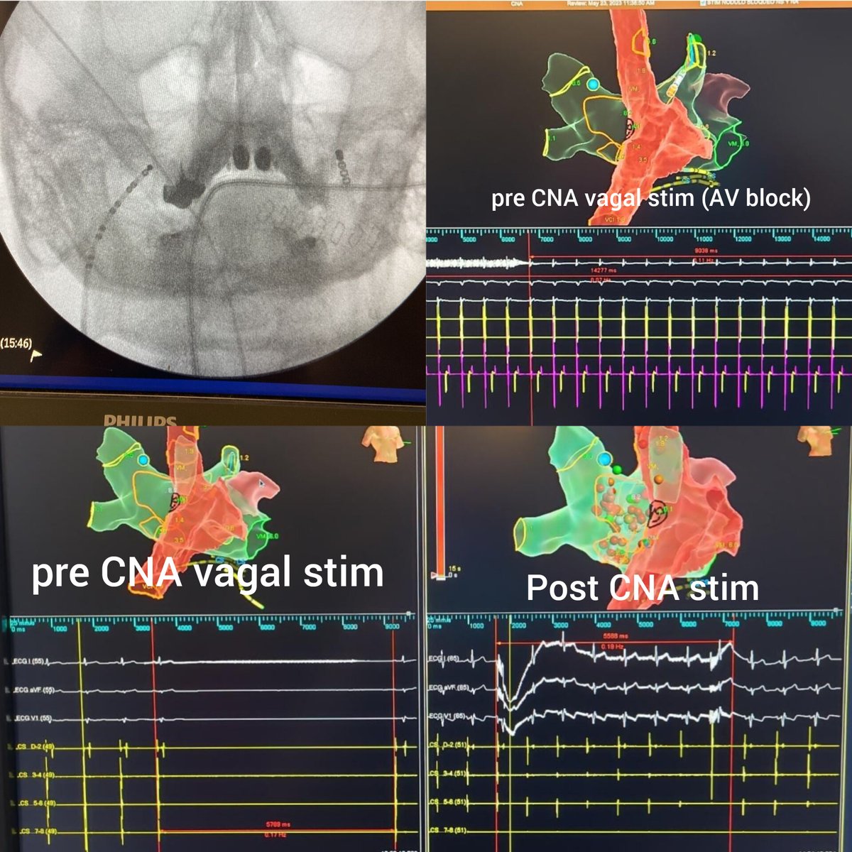 Nicolás Martinenghi (@nicolsmartinen2) on Twitter photo Male,52yo. Recurrent cardioinhibitory syncope. Amazing response to vagal neurostim pre (18 sec AV block) and post CNA. Thks to Carlos Pachon for the support.CAS <a href="/kamlofskymatias/">Matias Kamlofsky</a> #Epeeps <a href="/ArritmiasSAC/">Consejo de Arritmias SAC</a> <a href="/jczerpa/">JC ZERPA</a> <a href="/Aperezsilva77/">Armando Pérez Silva</a> <a href="/FScazzuso/">Fernando Scazzuso</a> <a href="/AzocarDamian/">Damian</a> <a href="/CarinaHardy4/">CarinaHardyEP</a> <a href="/OscarVazquezEP/">Dr. Oscar Vázquez</a> Male,52yo. Recurrent cardioinhibitory syncope. Amazing response to vagal neurostim pre (18 sec AV block) and post CNA. Thks to Carlos Pachon for the support.CAS <a href="/kamlofskymatias/">Matias Kamlofsky</a> #Epeeps <a href="/ArritmiasSAC/">Consejo de Arritmias SAC</a> <a href="/jczerpa/">JC ZERPA</a> <a href="/Aperezsilva77/">Armando Pérez Silva</a> <a href="/FScazzuso/">Fernando Scazzuso</a> <a href="/AzocarDamian/">Damian</a> <a href="/CarinaHardy4/">CarinaHardyEP</a> <a href="/OscarVazquezEP/">Dr. Oscar Vázquez</a>