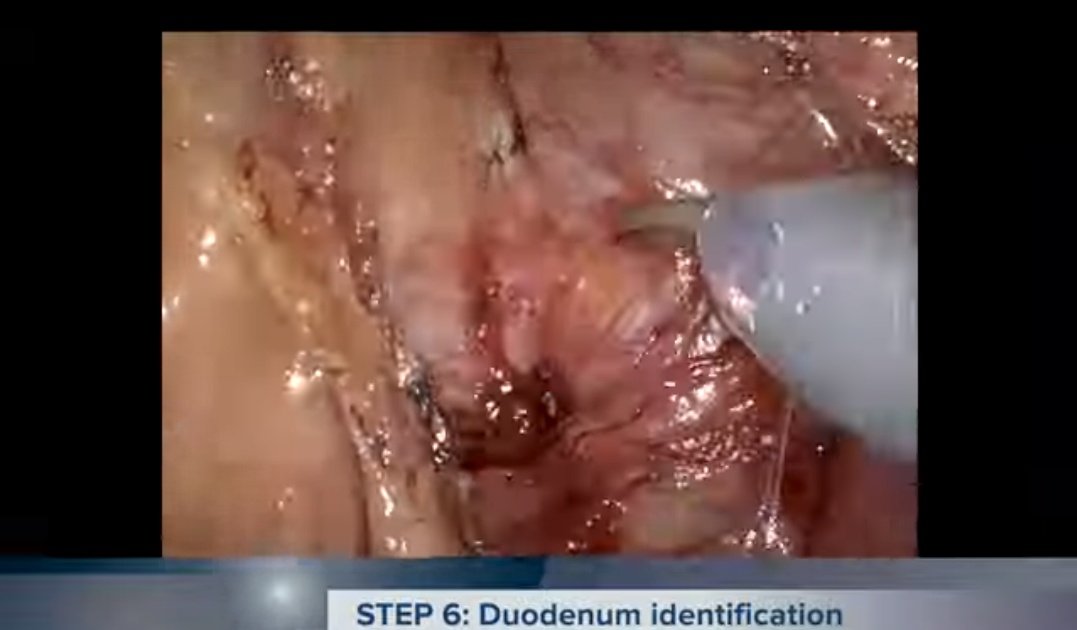 Colorectal Disease (@colorectaldis) on Twitter photo #TraineeTuesday🚦🚧🛑🚨
#StepByStep #robotic ®️colectomy with intracorporeal anastomosis by @jeremymeyer
#SoMe4Surgery #colorectalsurgery
<a href="/Dukes_Club/">The Dukes' Club</a> <a href="/YouESCP/">Young ESCP</a> <a href="/SAGES_Updates/">SAGES is in Tampa in 2026!</a> <a href="/ASCRS_1/">ASCRS_1</a> <a href="/PColorectal/">Portsmouth Colorectal</a> <a href="/coloproctoaec/">Coloproctología-AEC</a>
Watch it here👇
youtu.be/XjShiiLPW80 #TraineeTuesday🚦🚧🛑🚨
#StepByStep #robotic ®️colectomy with intracorporeal anastomosis by @jeremymeyer
#SoMe4Surgery #colorectalsurgery
<a href="/Dukes_Club/">The Dukes' Club</a> <a href="/YouESCP/">Young ESCP</a> <a href="/SAGES_Updates/">SAGES is in Tampa in 2026!</a> <a href="/ASCRS_1/">ASCRS_1</a> <a href="/PColorectal/">Portsmouth Colorectal</a> <a href="/coloproctoaec/">Coloproctología-AEC</a>
Watch it here👇
youtu.be/XjShiiLPW80
