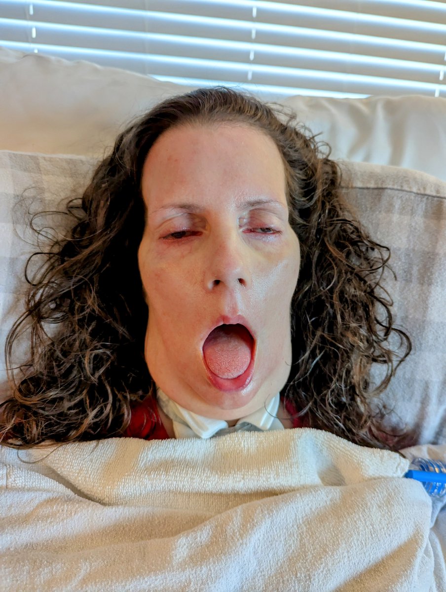 Kristin is dying of #ALS. You're MISTAKEN if you believe that HORRIFIC 100% FATAL ALS can't happen to YOU. CONGRESS, DEMAND that @FDACBER uses regulatory flexibility for this disease WITH NO SURVIVORS. @DrCaliff_FDA, grant NUROWN Accelerated Approval with a Phase 4