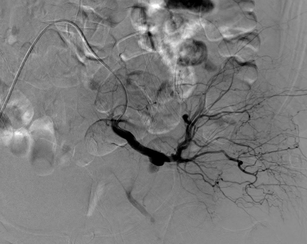 VirTauli's tweet photo. CASE REPORT

Mujer de 86a con plaquetopenia que tras biopsia de médula ósea cursa hTA y TC con muestras de sangrado activo. 

DSA muestra un pequeño pseudosneurisma dependiente de una rama de la arteria glútea superior y un gran pseudo que se origina del tronco posterior glúteo. https://t.co/apMRCwuAZ0