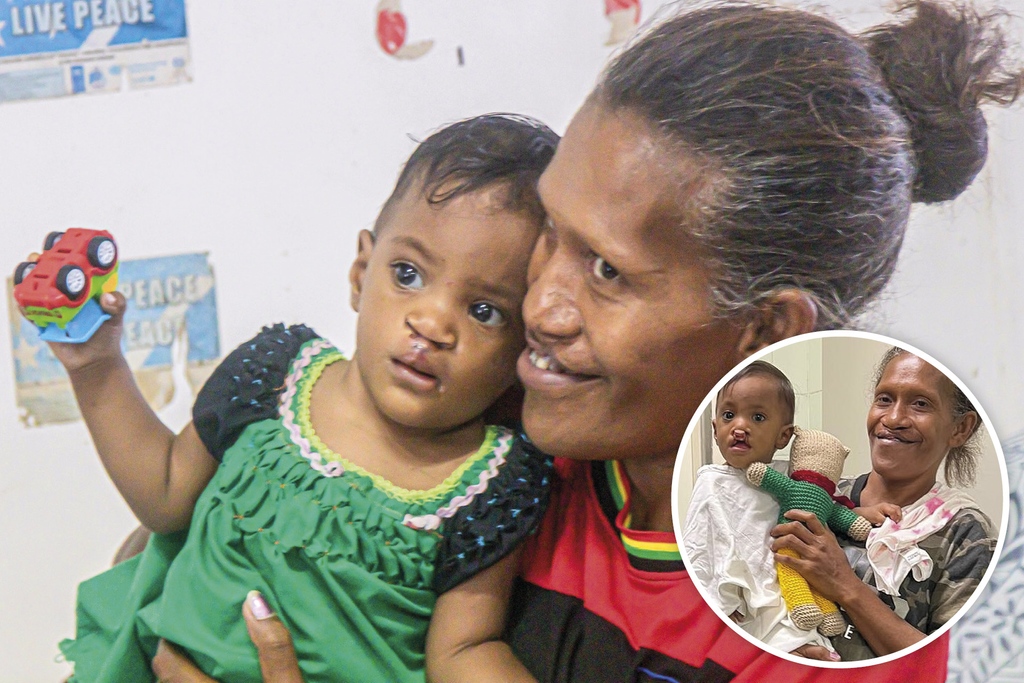 rotarydownunder's tweet image. Runella and her grandma after cleft lip surgery. INSET: Cleft lips and palates run in one-year-old Runella’s family. Her mum and grandmother (pictured) were also born with bi-lateral clefts 👉 bit.ly/3BNOD6L

#Interplast #Rotary