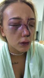 If u ever think you believe #AmberHeardIsALiar under oath she stated she covered her broken nose with makeup & ice
