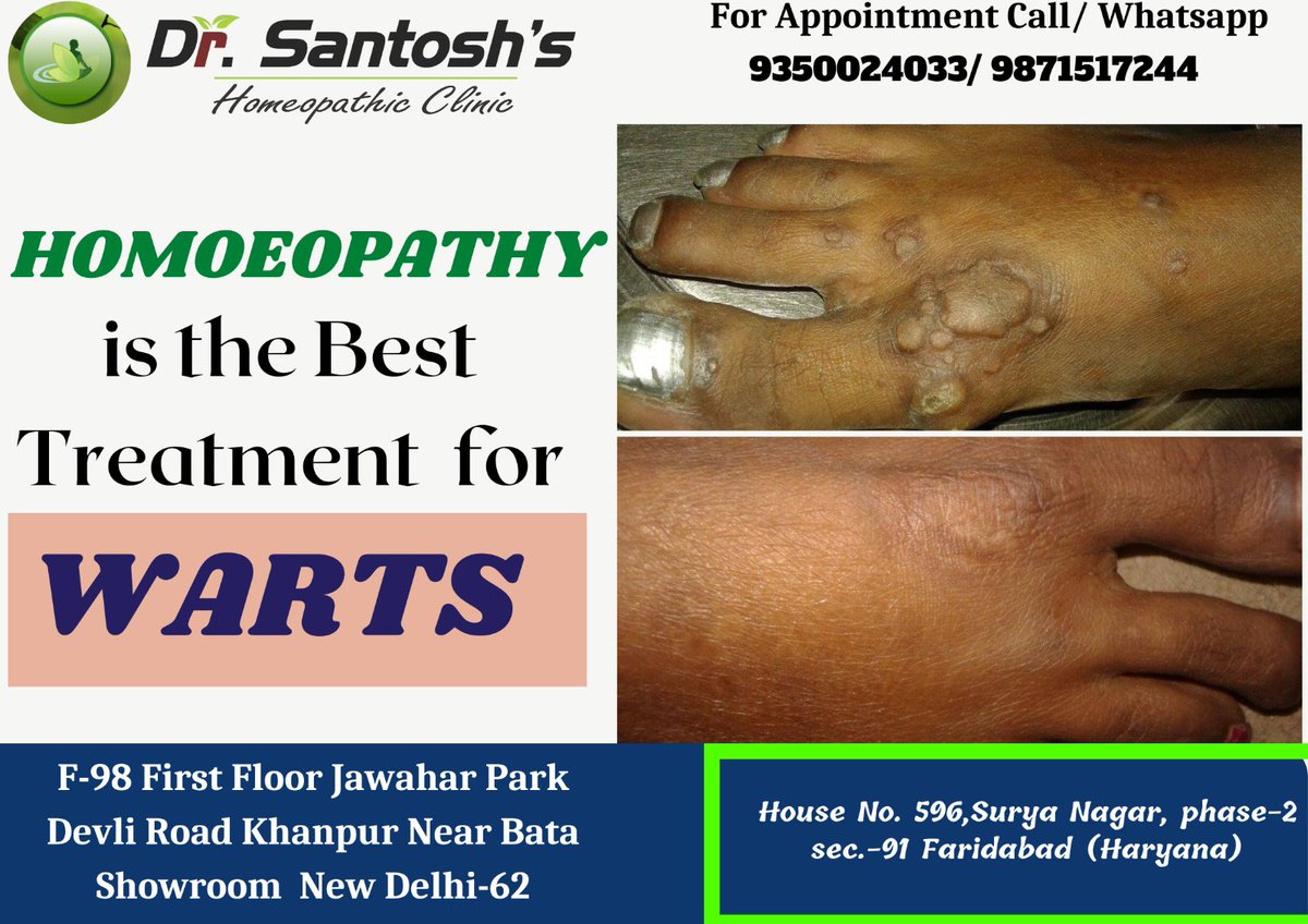 DrSantoshskuma1's tweet image. A small, fleshy bump on the skin or mucous membrane caused by human papillomavirus.

#homoeopathicmedicine 
#homoeopathicclinic
#homoeopathictreatment

Call us -9350024033/9871517244