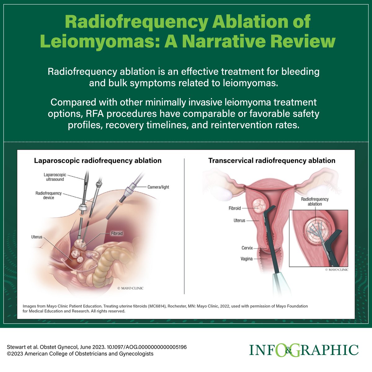 A comprehensive review of radiofrequency abolation of uterine leiomyomas, laparoscopic and transcvervical ow.ly/n8Uf30svq5q