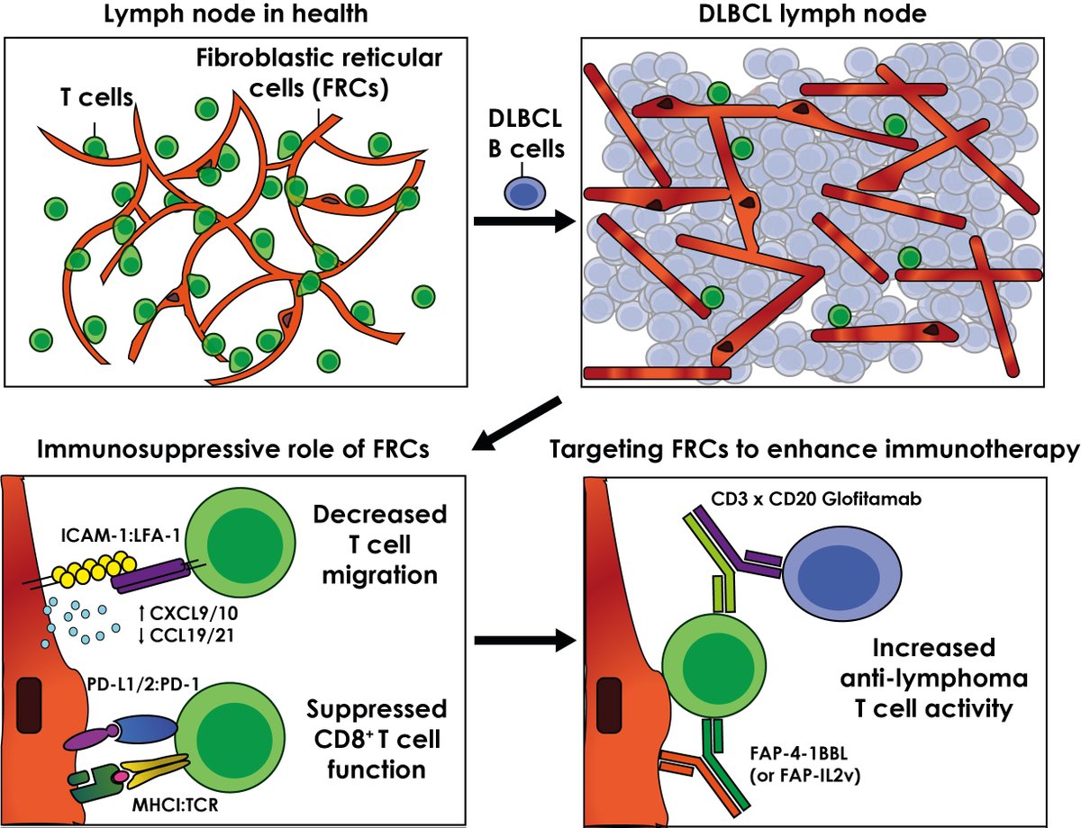Our study on lymph node fibroblasts in aggressive B cell #lymphoma is in-press @jclinicalinvest. We show an immunosuppressive role of #FRCs in #DLBCL with implications for immune evasion and #immunotherapy. Amazing work by Benedetta and collaborators! jci.org/articles/view/…