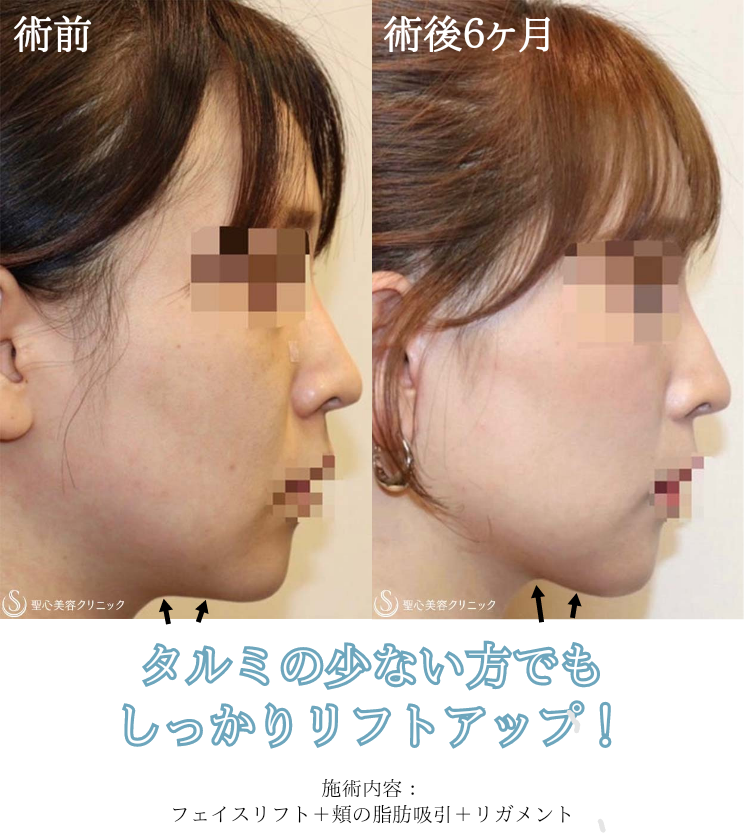 フェイスリフト超音波 フェイスリフト - 東京・銀座の美容外科クリニック｜WOM CLINIC GINZA