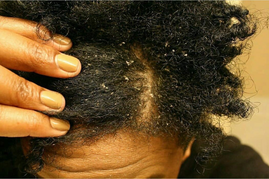 DermaSolutiongh's tweet photo. 2 for Ghc 60 p3✅️✅️

Anti-dandruff hair cream 

Treats dandruff and all scalp psoriasis

💯 effective

DM or Call 0205773069 

Kindly Retweet 🙏 

#Dermasolution
Kumawu  #PerfectMatchXtra  Assin North  50gh  UPSA https://t.co/NQD1T5fmbr