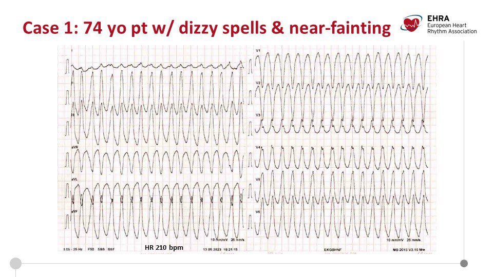 micaela_ebert's tweet photo. #EPeeps do you wonder what’s the current role of ablation for the treatment of VAs? 🤔 On 5 June 2023, 18:00 CEST @TobiasReichlin &amp; @KatjaZeppenfeld will provide case-based insights from the 2022 #EHRA_ESC GL for the management of pts with VA and prevention of #SCD https://t.co/odvyGpJNqU