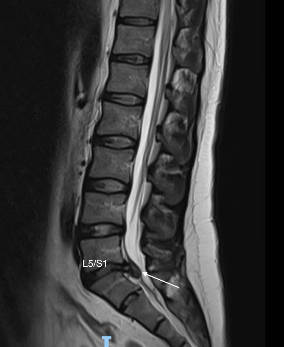 DrJN_SportsMed's tweet photo. Consent✅

"So it's likely your gluteal pain is due to a disc bulg.......whoaa"

Large extruded / sequestered L5/S1 herniation

Pain much ⬇️ since scan with no intervention, no neuro

Councelled re CES

These often resorb over time

Injections &amp; surgery not required at the point https://t.co/NR0nWJEe0l