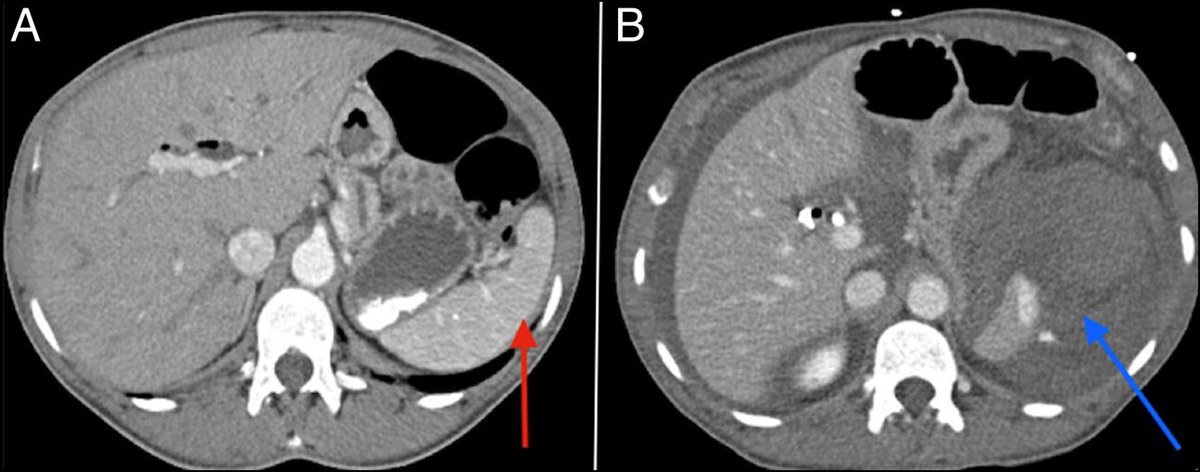 👉🏻 Splenic hematoma is a very unusual, albeit severe, complication after ERCP.

👉🏻 Only a few cases were reported in the literature in the past decades.

Read our newly published manuscript below 👇🏻 

@aboustanymd @ACGCRJ 

journals.lww.com/acgcr/Fulltext…