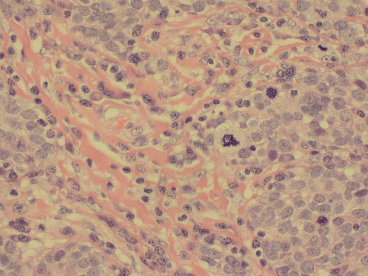 PathRuchi's tweet photo. Bilateral ovarian tumor.
What's the diagnosis? What IHC you would request
#pathtwitter #gynpath #Frcpath #onecaseaday https://t.co/t8YE7gek0t