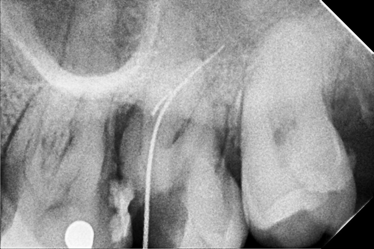 1 haftadır alet kırdım diye kahrımdan öldüm sonra by-pass ve gözyaşları kahkahalara karışır 🥲 #lovemyjob #dentistry