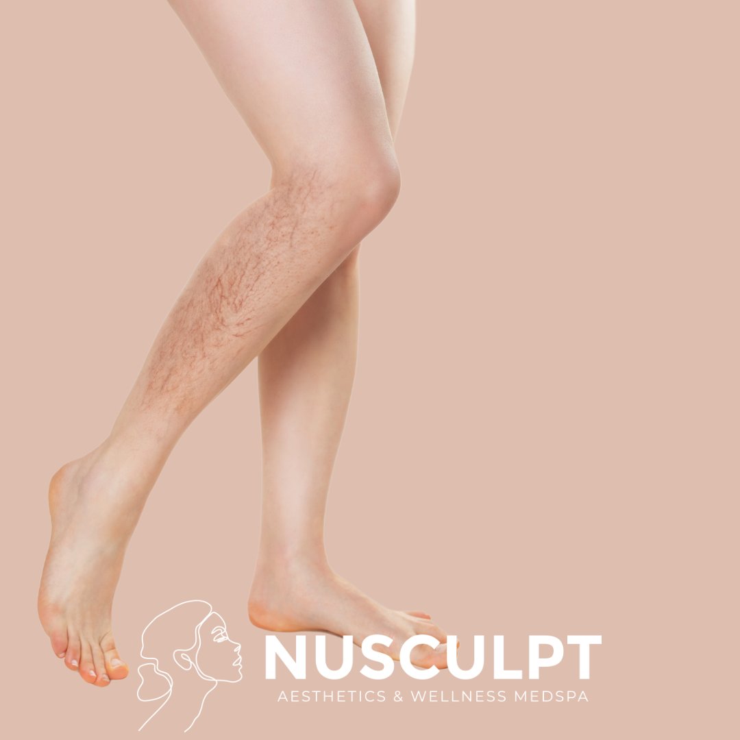 Say goodbye to those pesky varicose veins with sclerotherapy! 🙌 

Call us today or message us if you have any questions and to schedule your next visit! 859-331-0555

#Nusculptcrestviewhills #NusculptKY#legveins #legveinremoval #varicoseveinremoval