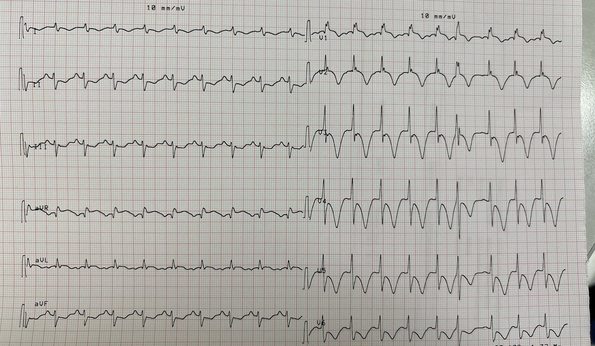 gonzaeperez's tweet image. #ECGfirst 
Nice case at #ClinicaOlivos 
68 yo 👵 Chest pain and atrial fibrillation. AF resolved spontaneously 

Thoughts? 🤔
@smithECGBlog @EM_RESUS @Vadeboncoeur_Al