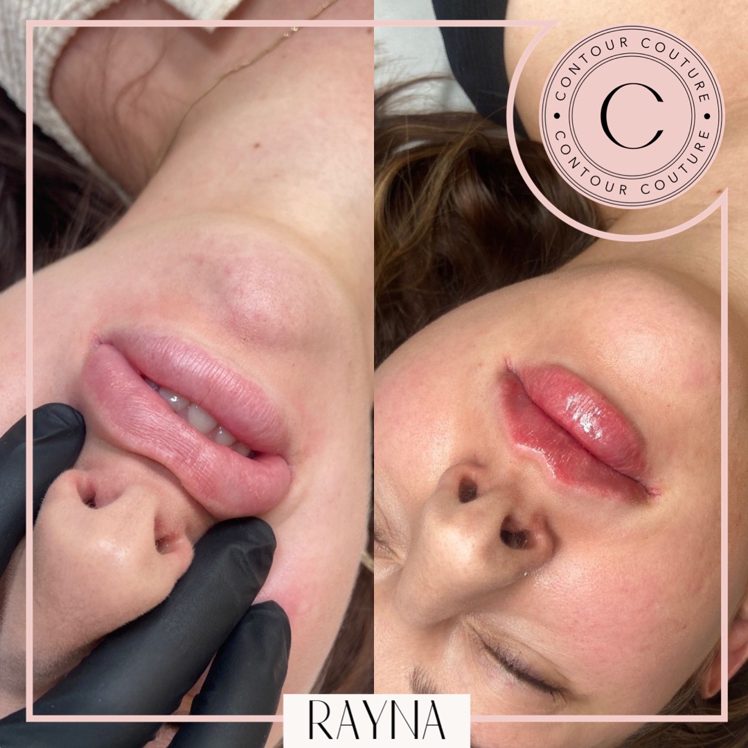 💥Dissolving before/Refill after 💥

 #lipfillersswindon #lipfillersbristol #lipfillerscheltenham #dissolving #revolax #perfectpout #fullerlips #dermalfillers #swindonbeauty #swindonbeautyclinic #bristolbeauty #aesthetics #bristollips #swindonaesthetics #lipfillers