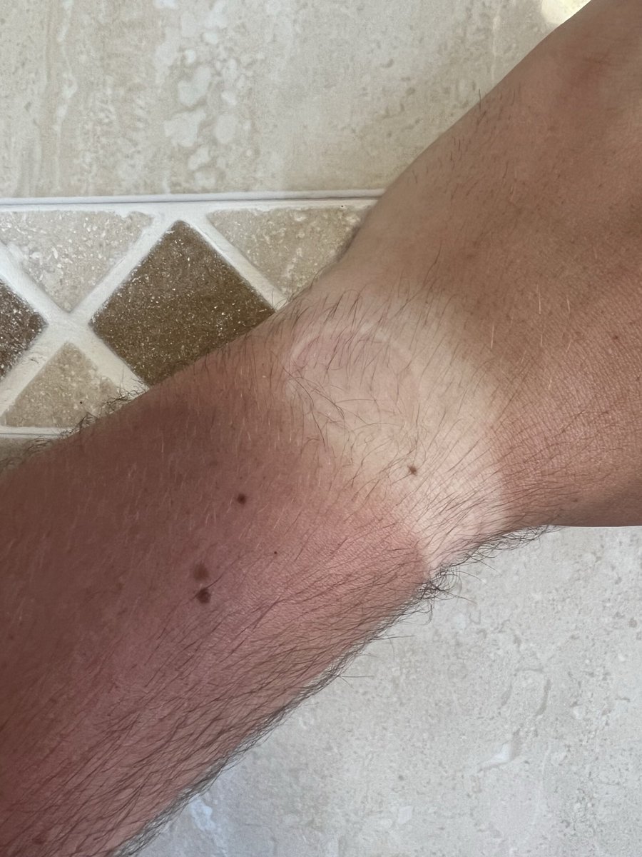 SMARTPE95's tweet photo. Today marks the first day of summer. Why? Look at that PE Teacher tan! 😂#PEproblems #summeriscoming https://t.co/rBqae727P1