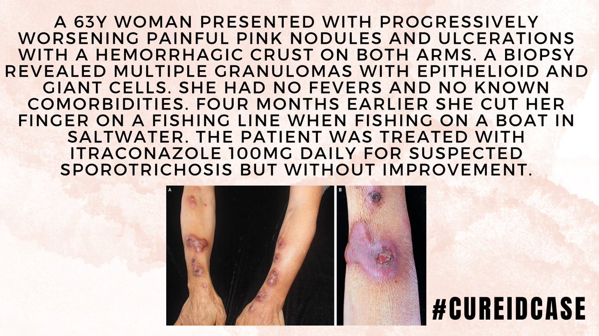 id_cure's tweet photo. #CUREIDCase
Find more details on CURE ID that will help you make the correct diagnosis:
https://t.co/HRbbOhce0x
#IDTwitter #IDMedEd #MedEd #IDCase #CUREID https://t.co/apzCjWtpqr