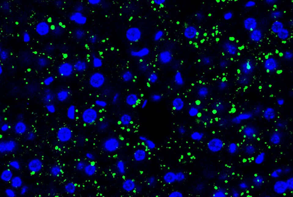RobSchwartzLab's tweet photo. Cancer is known to cause systemic effects in patients. In collaborative work with David Lyden and Haiying Zhang we found that tumors produce particles that reprogram the liver to a fatty liver state and alters drug metabolism. https://t.co/JMZlJhWfMq #Exosomes #Cancer #Liver https://t.co/NFWtJVEfNV