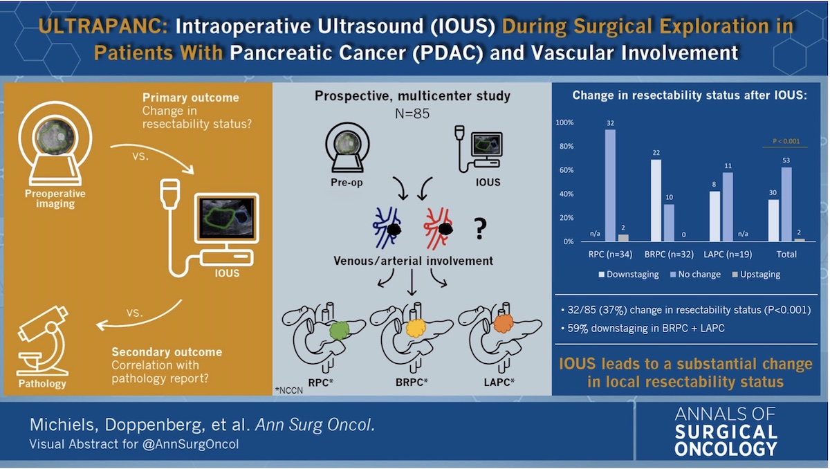 #IntraoperativeUltrasound During #SurgicalExploration in Patients with #PancreaticCancer and Vascular Involvement ( #ULTRAPANC ): A Prospective Multicenter Study rdcu.be/dcTOz #VisualAbstract