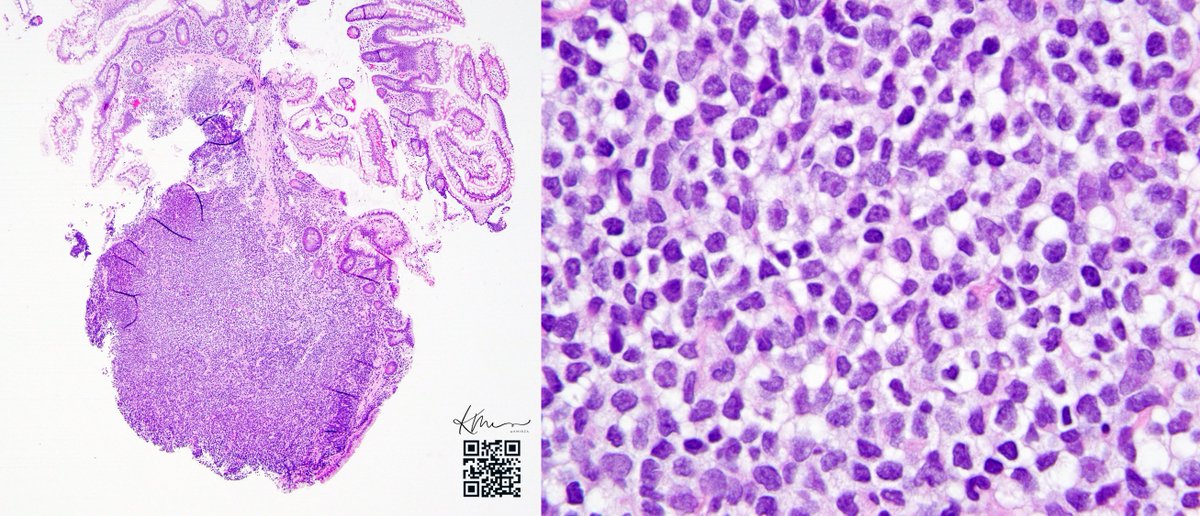 #Mantle cell lymphoma presenting as lymphomatoid (or lymphomatous) polyposis in an ileal nodule #lymsm #hemepath CD20+ CD5+ CyclinD1+ CD10-
