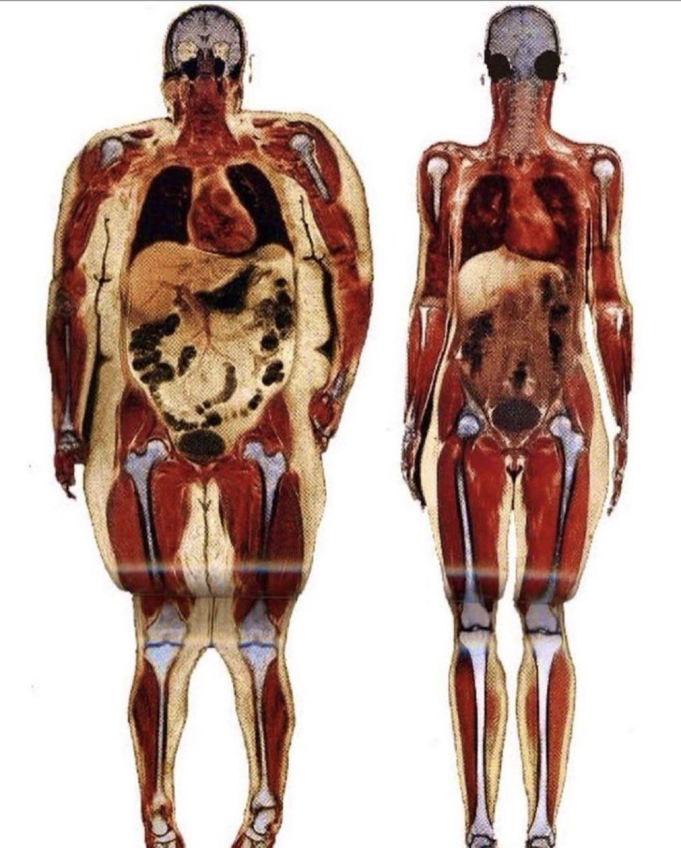 🙋‍♂️ Extraordinary scans reveal what obesity does to a human
#MedEd #FOAMed #obesity  #nutrition #dietitian #TipsForNewDocs #Medical #Medstudents #NutritionMatters #Health