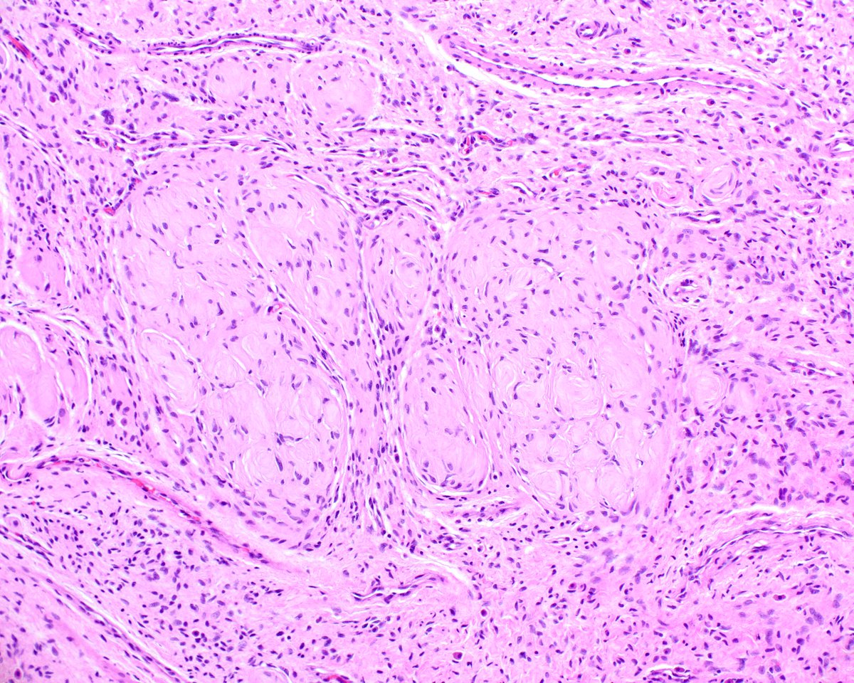This is a beautiful diffuse neurofibroma, characterized by the presence of Wagner Meissner (tactoid) bodies. innovativesciencepress.com