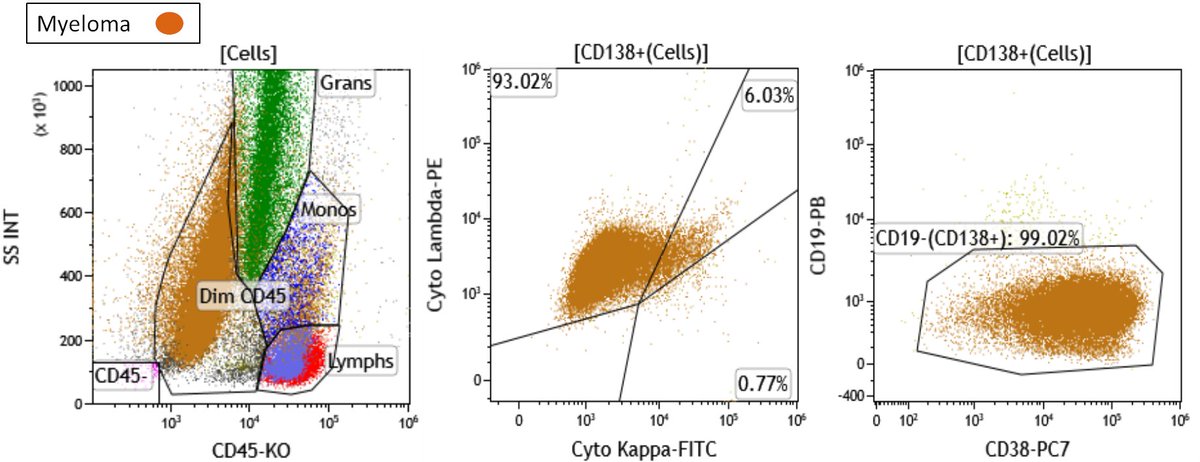 Bone marrow involvement by previously established myeloma (population labeled 1), marginal zone lymphoma (population 2) & CLL/SLL (population 3) #hemepath #lymsm #PathTwitter #MedTwitter @ICCS_Education @saada_vsaada