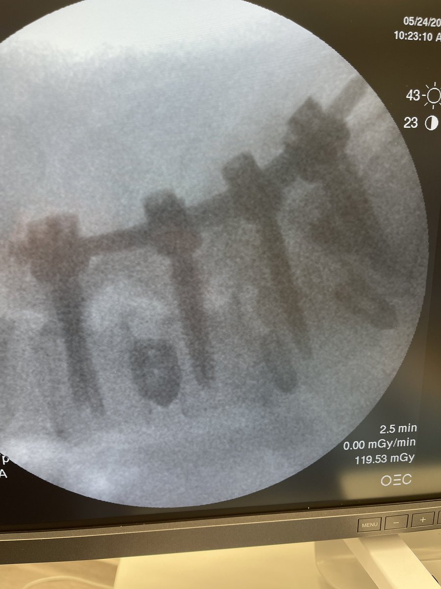 The joy of watching a 3 level fusion patient walking out of your suegery center just after 4 hours: A fantastic day in our surgery center and start with a great team: L2-S1 trans kambin OLLIF in 78 and a sacro iliac joint fusion in 14 minutes skin to skin.