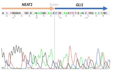 🧬Can RNA-based sequencing help classify sarcomas in patients aged <40 years?

🔍See the findings in the article below 👇

pathologyjournal.rcpa.edu.au/article/S0031-…

#BSTpath #MolDx #PathTwitter #PathResidents