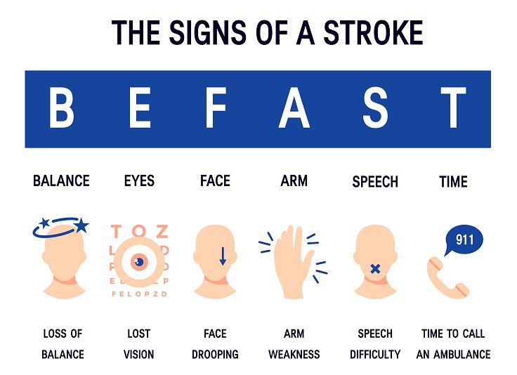 Strokes are BAD.  The clock starts at the very onset of your symptoms.  It is critical to 1) recognize symptoms and 2) to call 911.  Even if you are not sure-> ACT.  Let us figure out in the ER. Your outcome and the rest of your life depend on it!
#StrokeAwarenessMonth #actfast