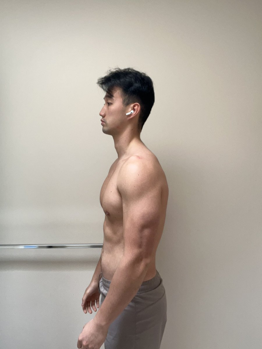 adrianleungfit's tweet photo. #Vulnerabilitypost
I said I was going to document my journey towards the Vancity Showdown 2023
So here is it.
First set of progress pictures.
4.5 months out.
I have a BURNING desire everyday to be at my best at everything I do.
I truly believe that everything I write down on paper eventually becomes reality.
Fitness, business, relationships.
So, Itโs either an all in bet or no bet at all.
And ALL of my chips are in towards conquering this new challenge in my life.
When the student is ready to learn, the teacher will appear @adam_aesthetics
LFG ๐บ
#vancityshowdown #mensphysique #bodybuilding #vancouverbc #vancouver