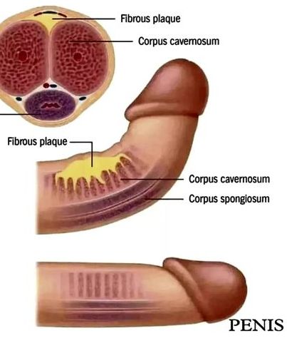 Reason why some penis are not straight!!

Peyronie's disease

is a noncancerous condition resulting from fibrous scar tissue that develops on the penis and causes curved, painful erections. Penises vary in shape and size, and