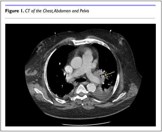 Prrmojeditor's tweet photo. An Unusual Presentation of New Onset Sarcoidosis.
by Christian Dresser, MD [ISSN 2377-1658]

📖Read the full article here: https://t.co/FHxmOopW1n

✍Submit your manuscript: https://t.co/3HXd03s0i1

#openventio #weightloss #hilarlymphadenopathy #fatigue #shortnessofbreath https://t.co/oaxbA8sPyg