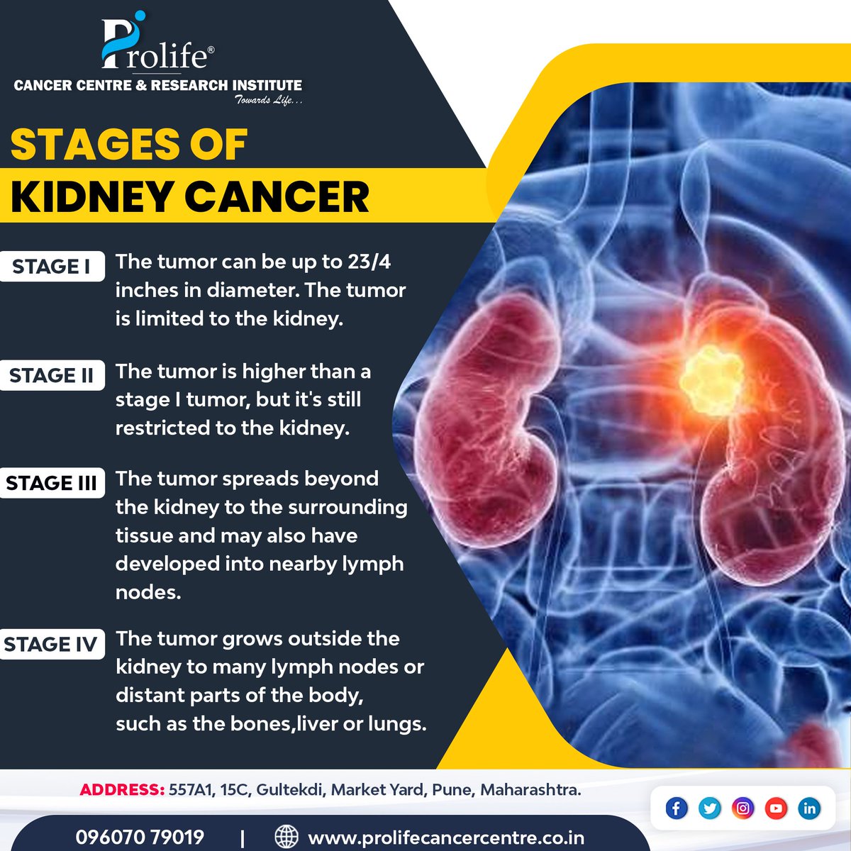 Unveiling the Journey of Kidney Cancer: From early detection to advanced challenges. Let's raise awareness about the stages of Kidney Cancer - Stages I to IV. Consult Dr. Sumit Shah at Prolife Cancer Centre.
.
#kidneycancer #prolifecancercentre #drsumitshah #pune