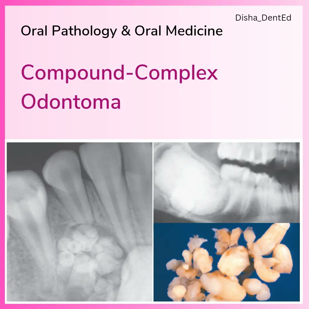 Disha_DentEd's tweet photo. Oral Pathology_ Compound-Complex Odontoma
Q: Radiopaque mass composed of multiple small tooth-like structures are _______ Odontoma.
Comment your answer below π
#dentistry #dentalnotes #bds #dentalexam #dental #dentistrynotes
#oralpathology https://t.co/5xpNyeFIxE